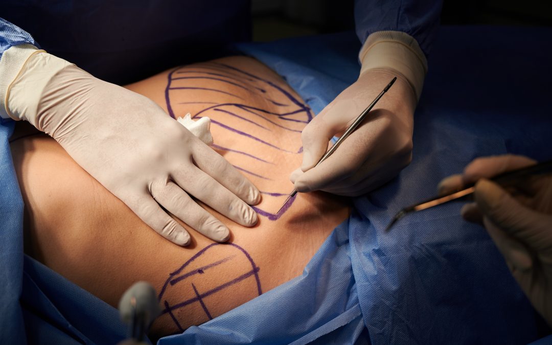 What is Abdominoplasty Surgery?