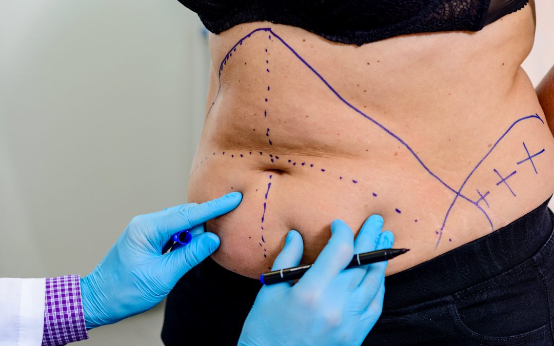 Doctor drawing surgical lines on a woman's stomach.