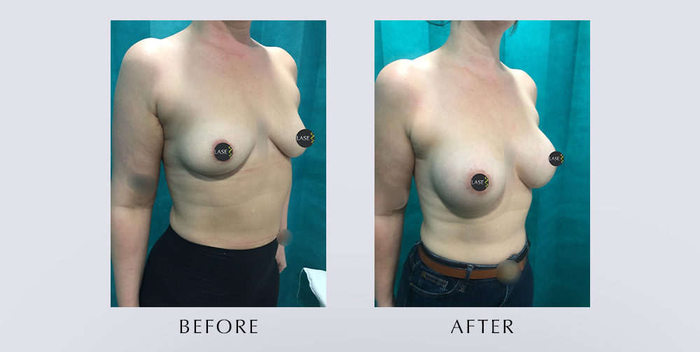 images showing a breast augmentation before and after