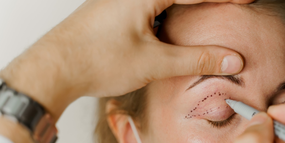 Blepharoplasty markup close-up on the face