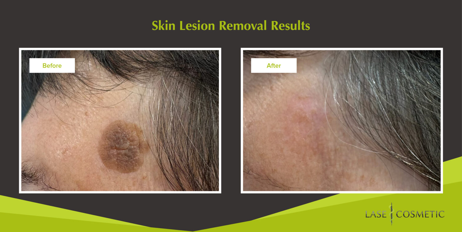 skin lesion removal results before and after