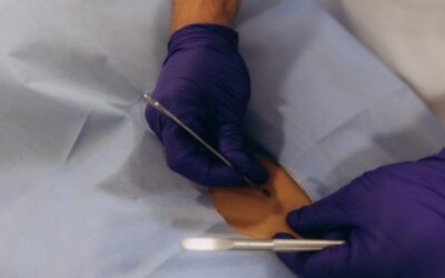Skin Lesion Removal: What It Involves & When to Consider It