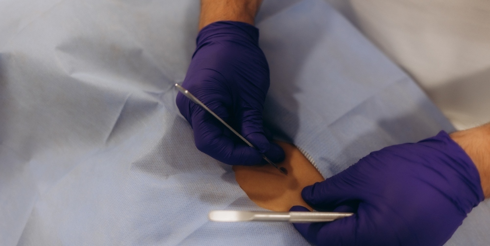 Skin Lesion Removal: What It Involves & When to Consider It
