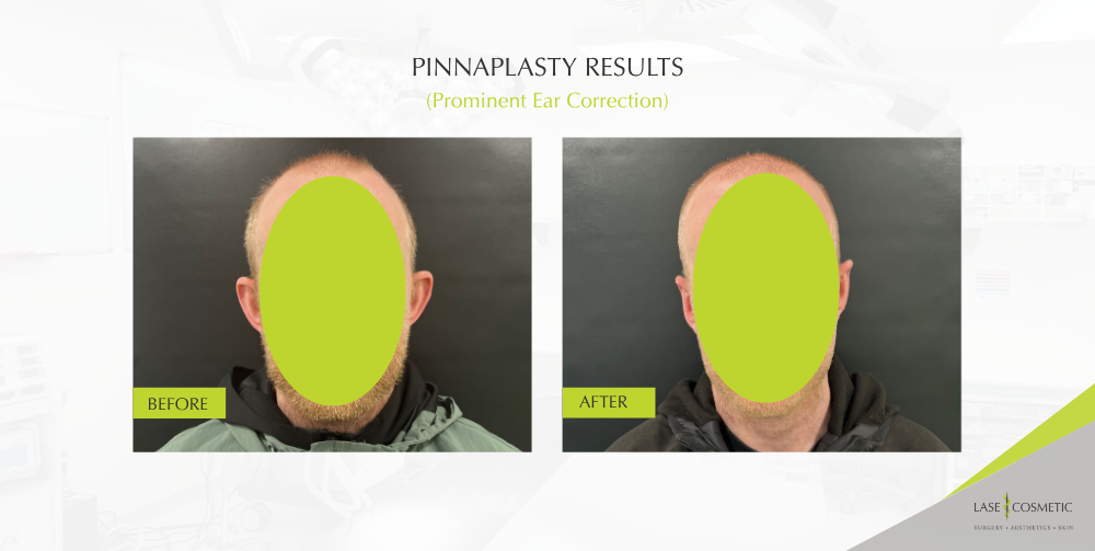 image showing before and after pinnaplasty surgery