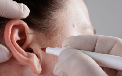 What Is Pinnaplasty and How Much Does Pinnaplasty Cost?