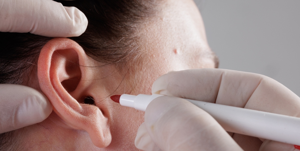 What Is Pinnaplasty and How Much Does Pinnaplasty Cost?