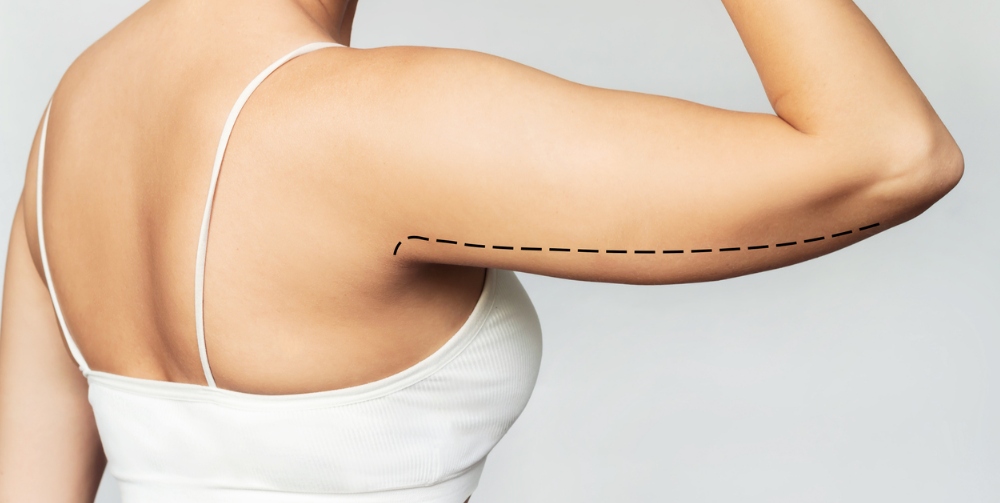 person lifting arm with pen marks on it for surgery