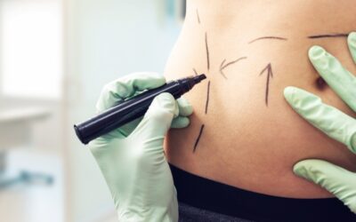 How Much Does Liposuction Cost? Your Complete Guide