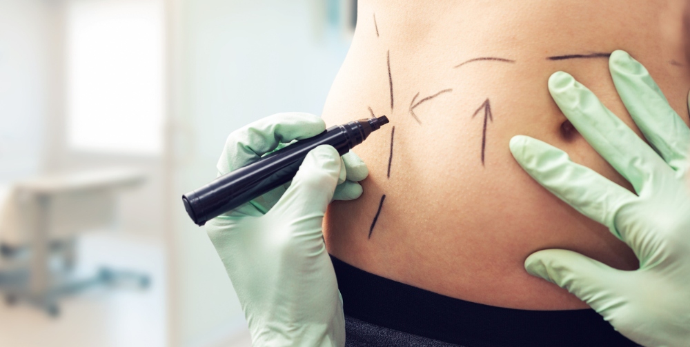 How Much Does Liposuction Cost? Your Complete Guide