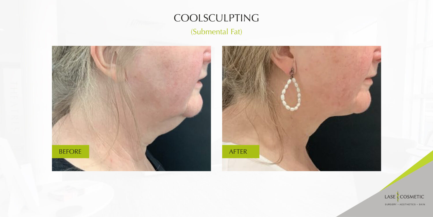 CoolSculpting before and after results