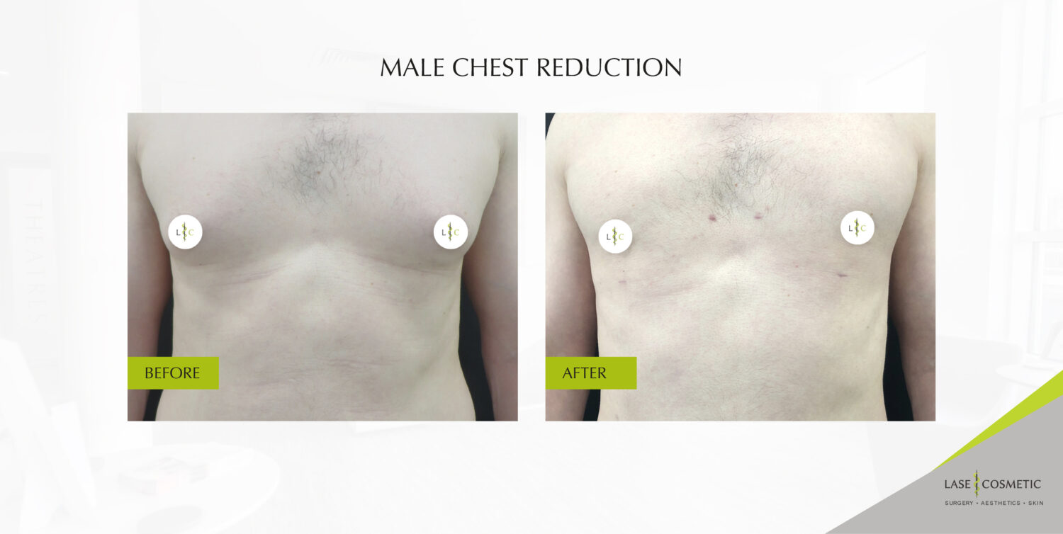male chest reduction results before and after