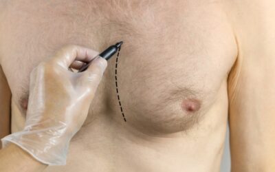 How Male Chest Reduction Can Help You Feel More Confident