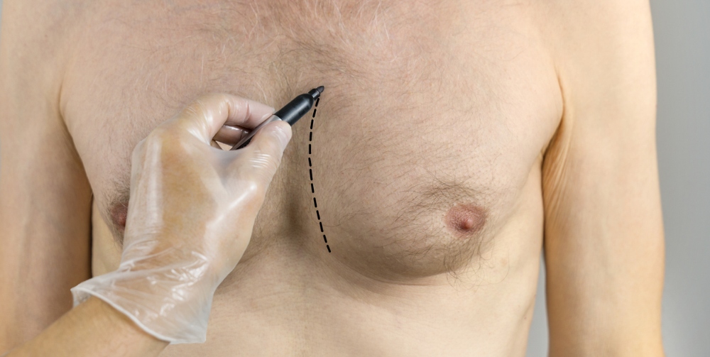 Plastic surgeon draws surgical plans before male chest reduction