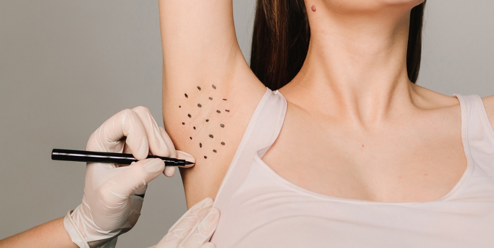 clinician marking dots before injecting woman's armpit, closeup