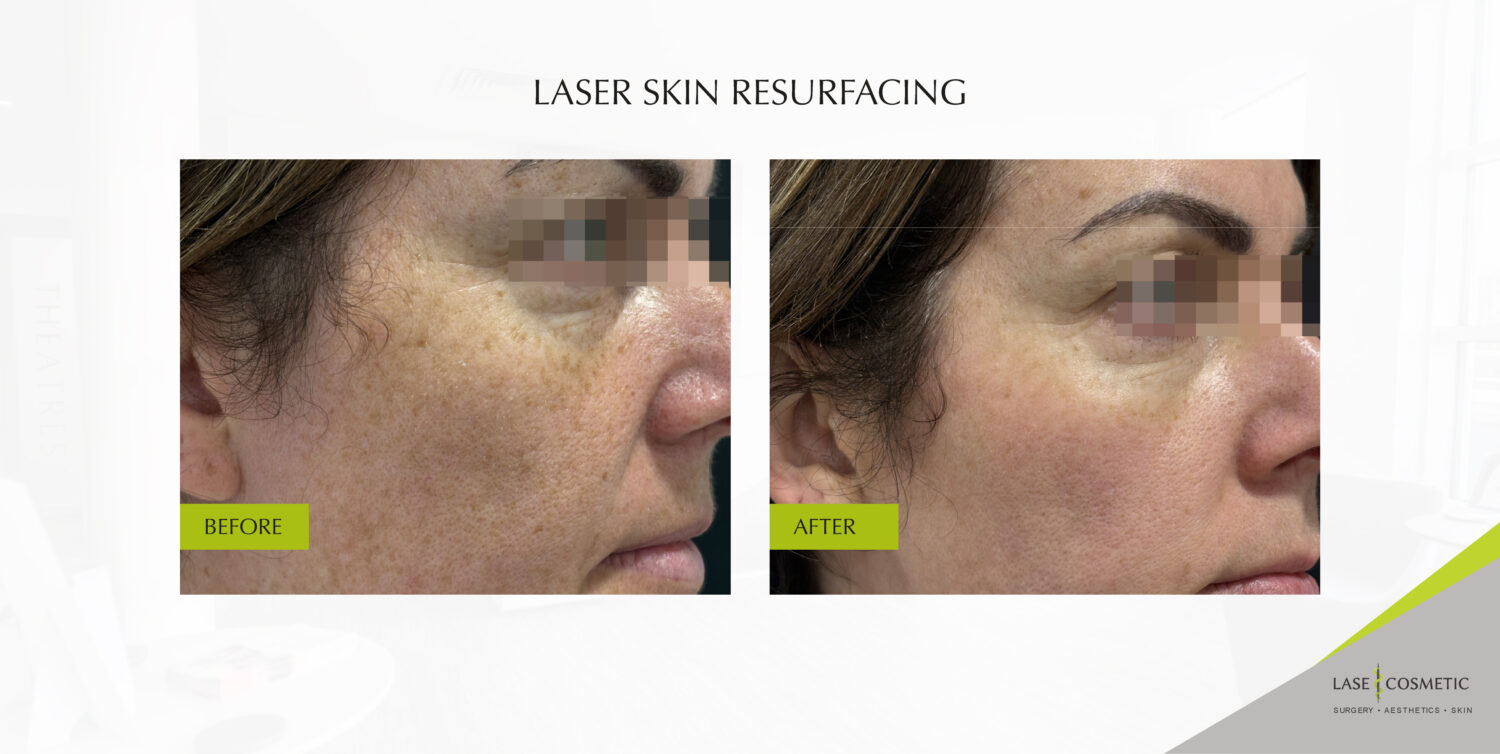 before and after images showing laser skin resurfacing results