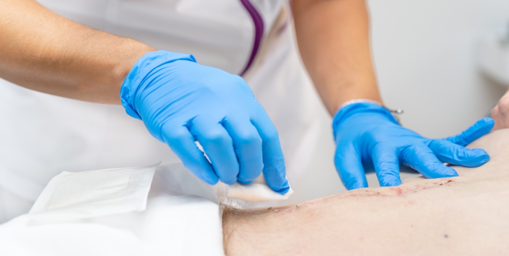 clinician removing skin lesion from persons back